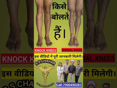 #knockknees #sscgdmedicalfulldetails #indianparamilitaryforces #pre_medical #army #rwa