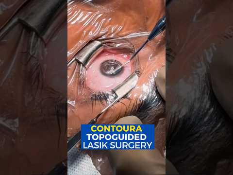 Live Contoura Topo-guided Lasik Surgery